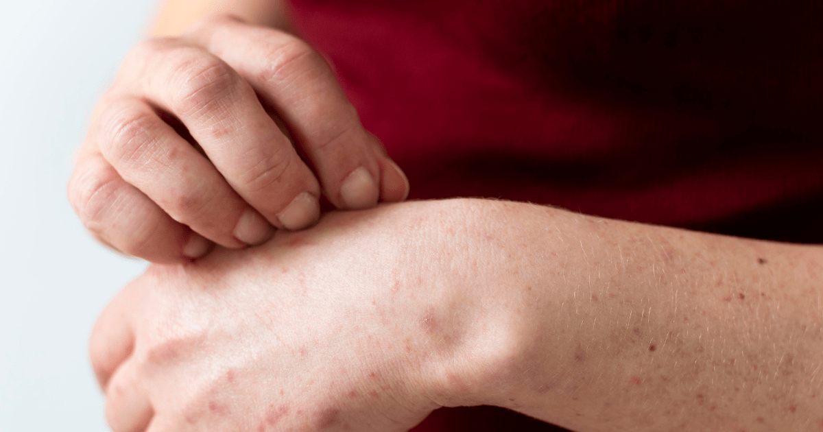 مرهم لعلاج حكة المهبل